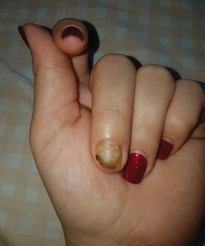 Green nail syndrome on the nail plate and bed related with Enterococcus and  Fusarium coinfection